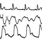 Венный пульс