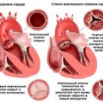 Виды аортального порока сердца