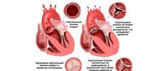 Виды аортального порока сердца