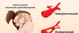 Types of stroke