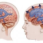 Внутричерепное давление у грудничков: симптомы, признаки, лечение таблетками, лекарствами, последствия. Норма и повышенное