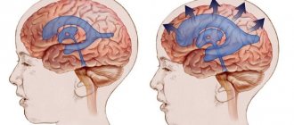 Intracranial pressure in infants: symptoms, signs, treatment with pills, medications, consequences. Normal and increased