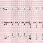 Вольтаж экг снижен что это значит