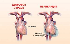 Воспаление оболочки сердца при перикардите