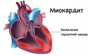Воспаление сердечной мышцы при миокардите сердца