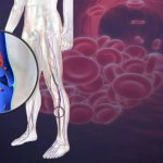 Воспалилась вена на ноге: что делать? Как лечить в домашних условиях?