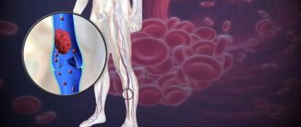 A vein in the leg is inflamed: what to do? How to treat at home?