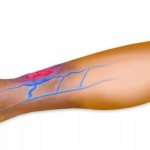 Воспалилась вена на ноге: что делать? Как лечить в домашних условиях?