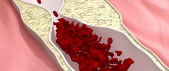 Заболевание периферических артерий