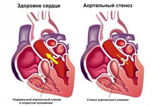 Здоровое сердце и аортальный стеноз