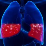 Жидкость в легких. Причины, почему скапливается, как откачивают, лечение и последствия