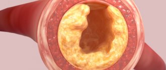 Fat embolism of blood vessels causes
