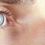 Зрение после инсульта