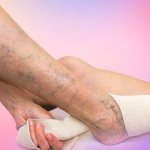 Зуд ног при варикозе фото 3